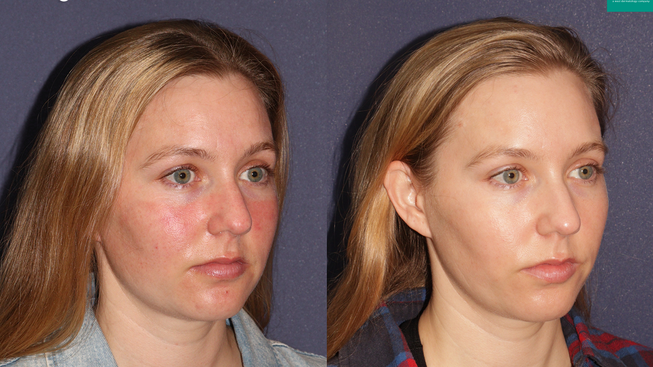 IPL Photo Facial1