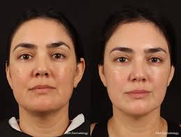 IPL Photo Facial3