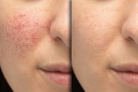 IPL Photo Facial4